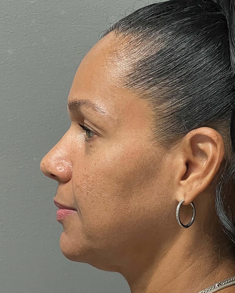 Blepharoplasty Before & After