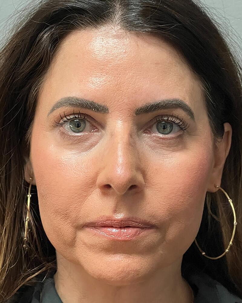 Blepharoplasty Before & After