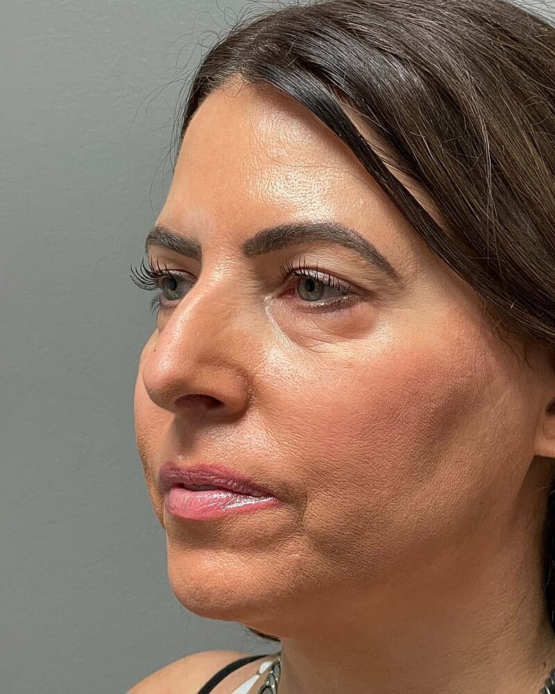 Blepharoplasty Before & After