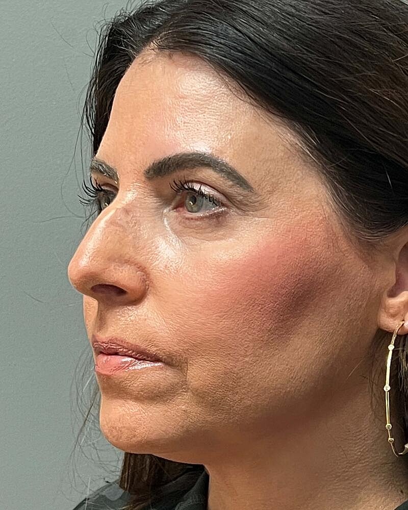 Blepharoplasty Before & After