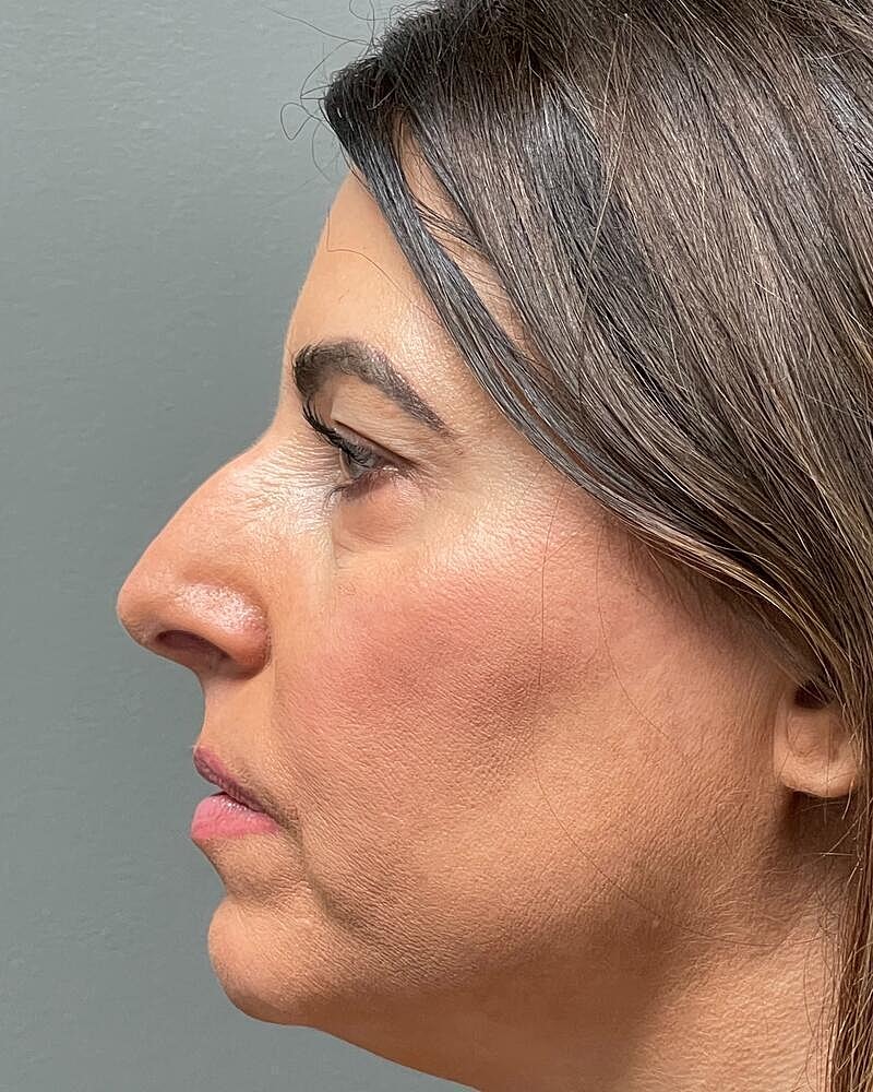Blepharoplasty Before & After