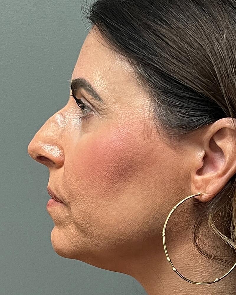 Blepharoplasty Before & After