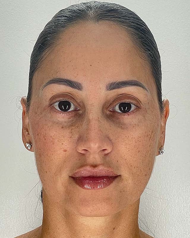 Blepharoplasty Before & After