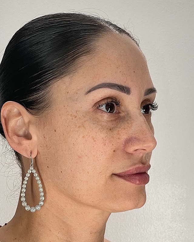 Blepharoplasty Before & After
