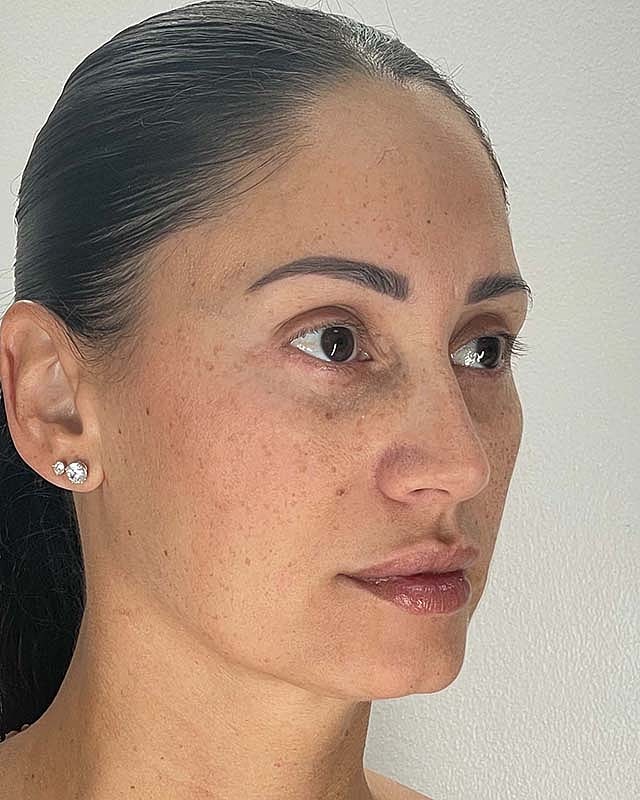 Blepharoplasty Before & After
