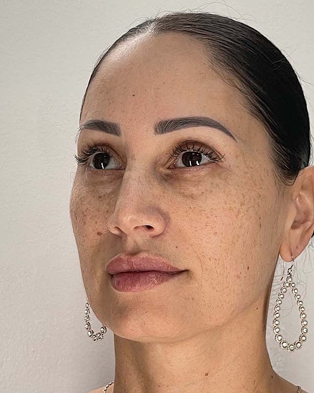 Blepharoplasty Before & After