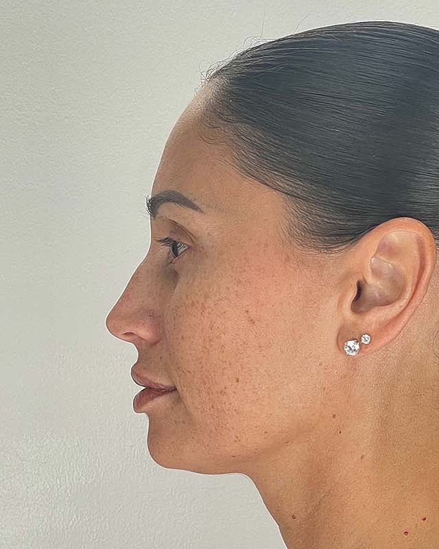 Blepharoplasty Before & After
