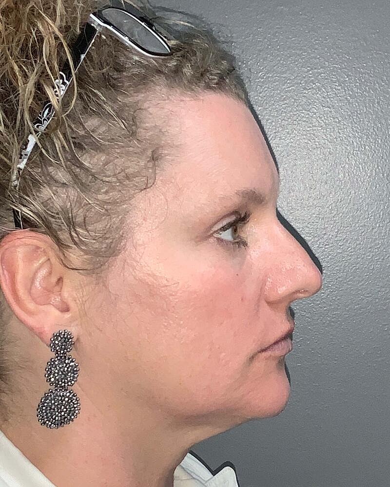 Blepharoplasty Before & After