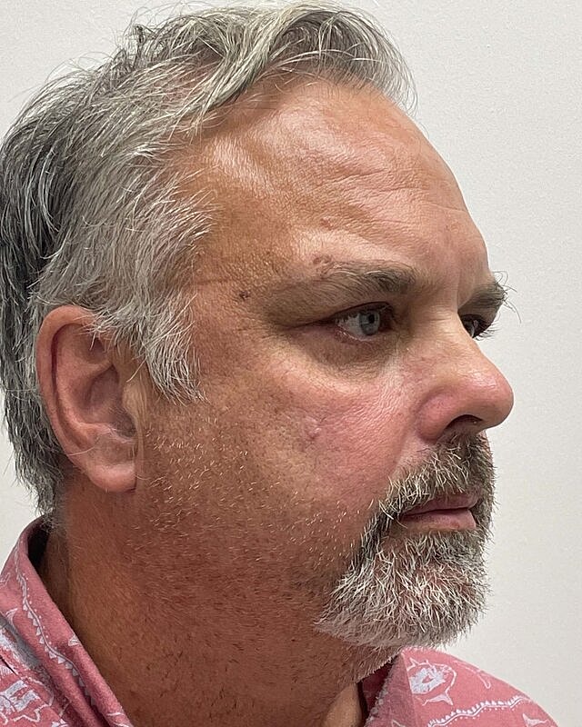 Blepharoplasty Before & After