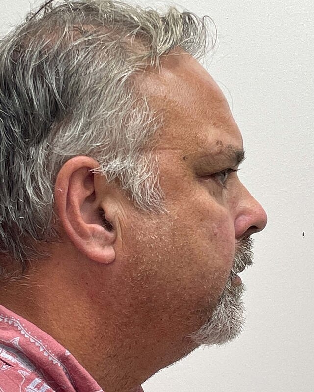 Blepharoplasty Before & After