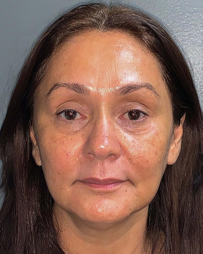 Blepharoplasty Before & After