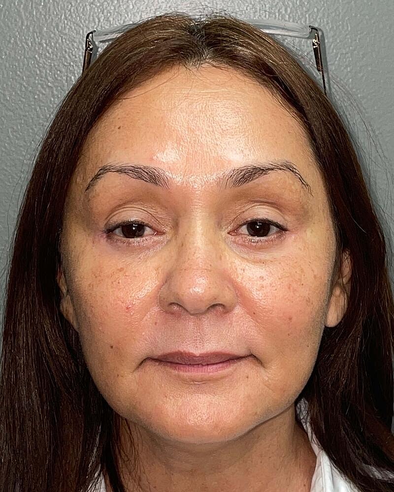 Blepharoplasty Before & After