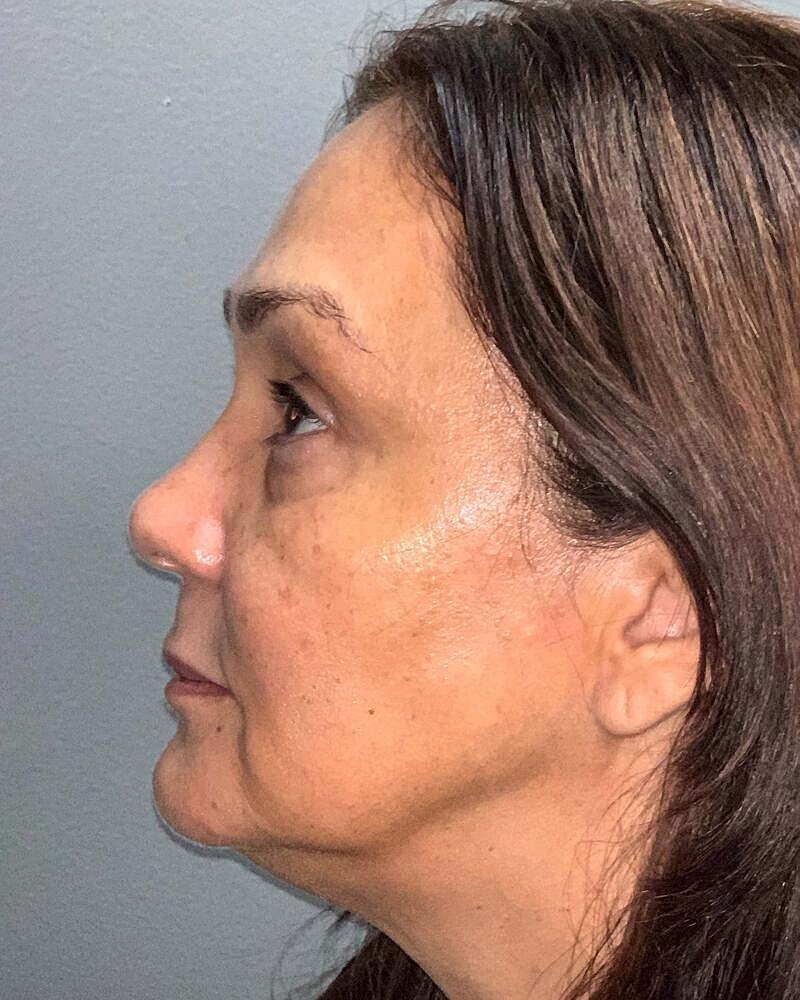 Blepharoplasty Before & After