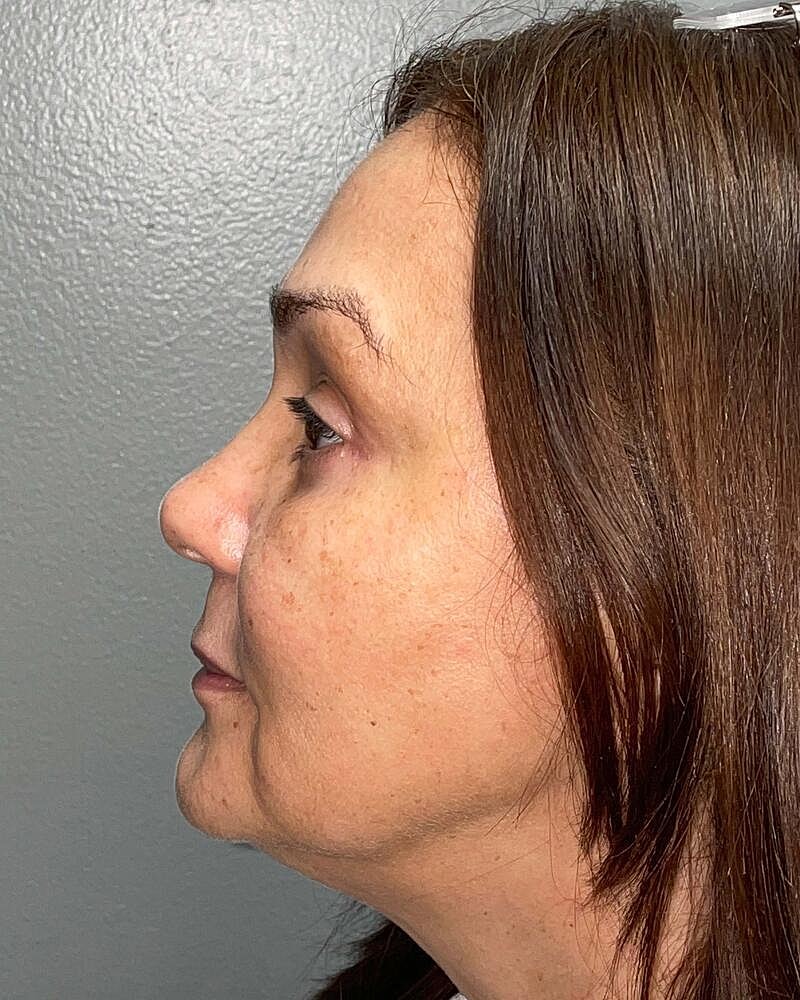 Blepharoplasty Before & After