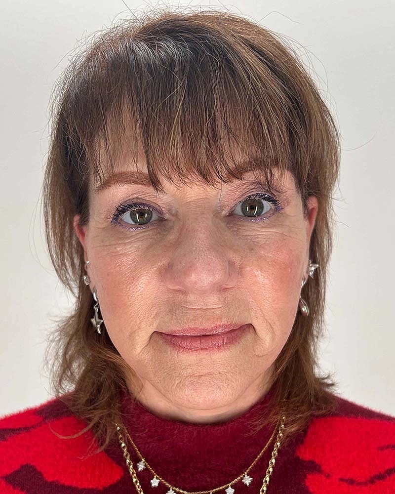 Blepharoplasty Before & After