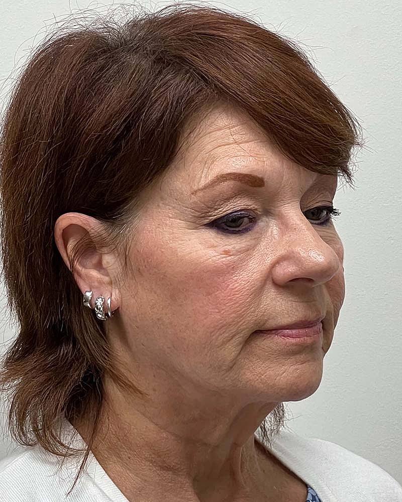 Blepharoplasty Before & After