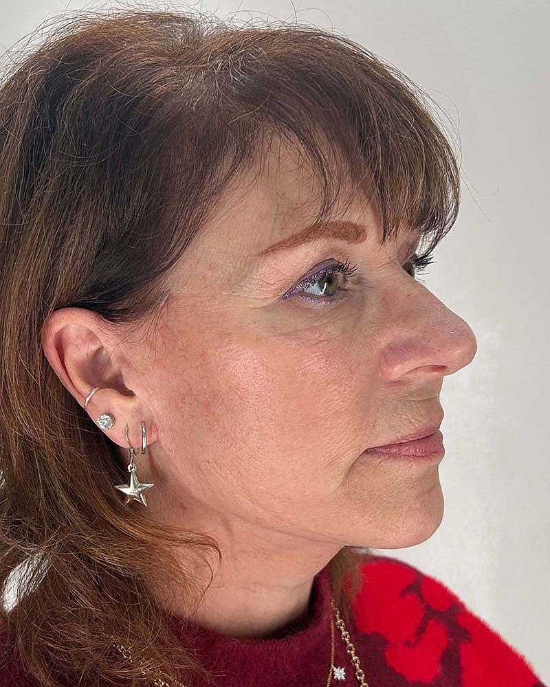 Blepharoplasty Before & After