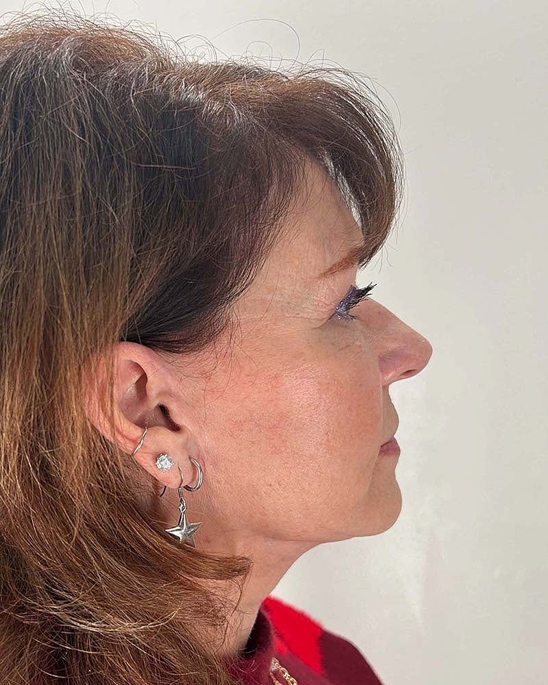Blepharoplasty Before & After
