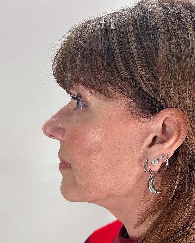 Blepharoplasty Before & After
