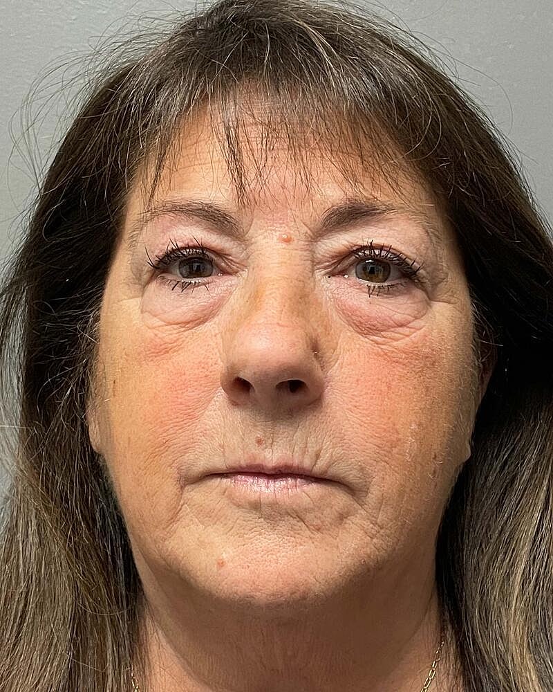 Blepharoplasty Before & After