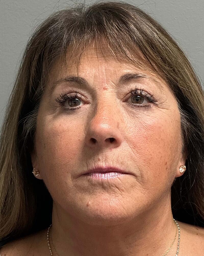 Blepharoplasty Before & After