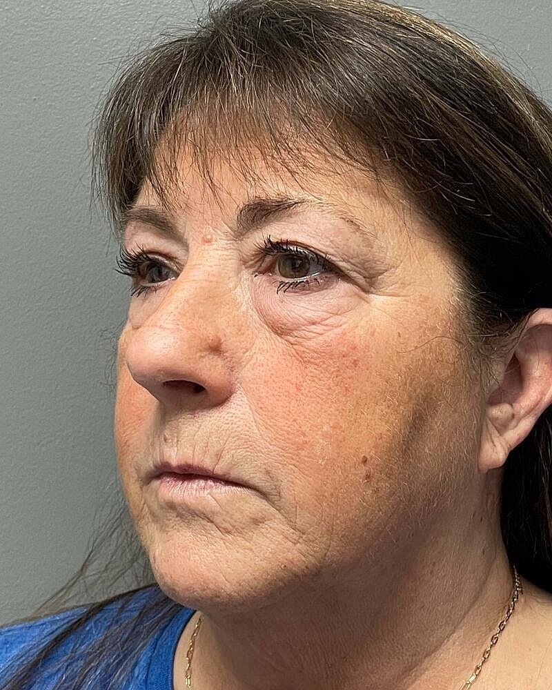 Blepharoplasty Before & After
