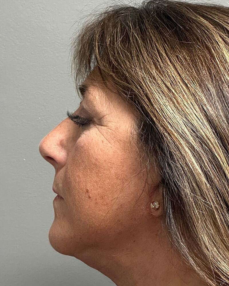 Blepharoplasty Before & After