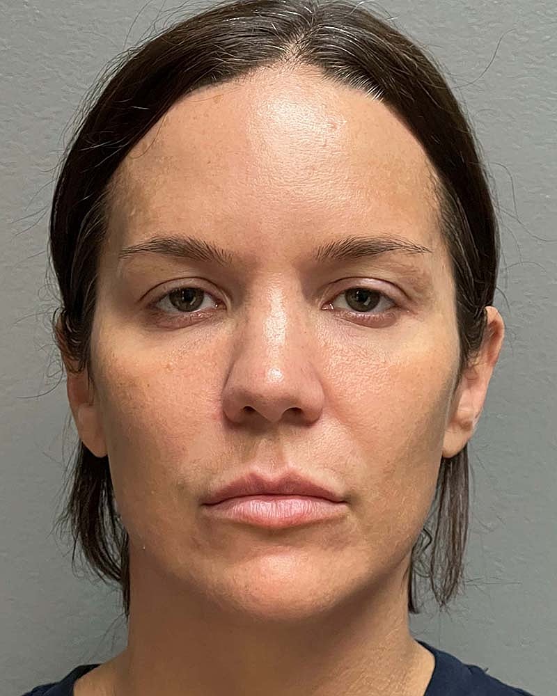 Blepharoplasty Before & After