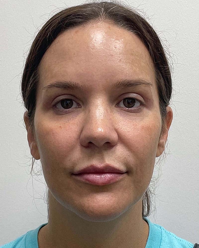 Blepharoplasty Before & After