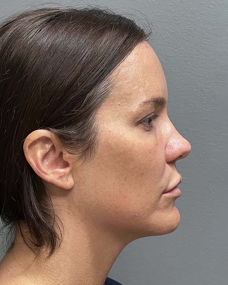 Blepharoplasty Before & After