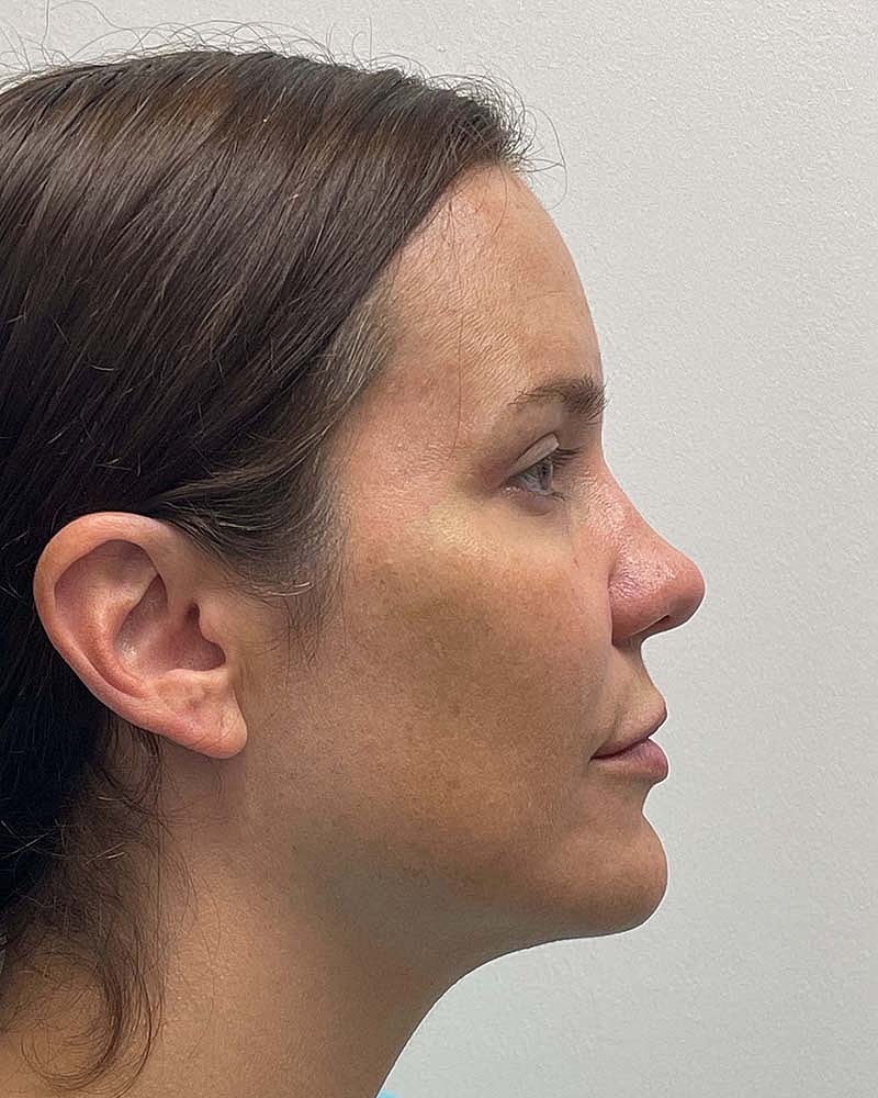 Blepharoplasty Before & After