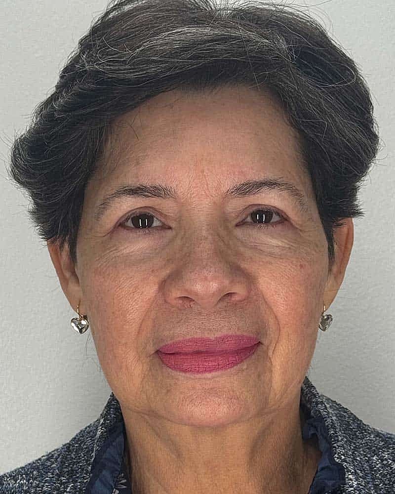Blepharoplasty Before & After