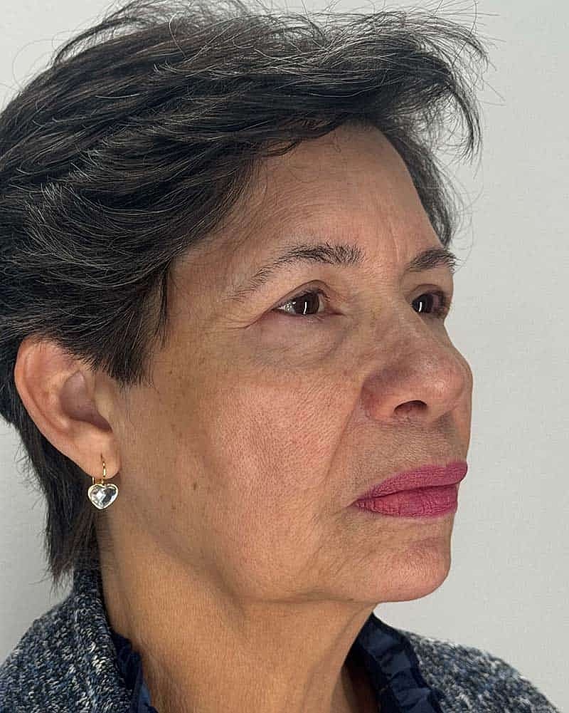 Blepharoplasty Before & After