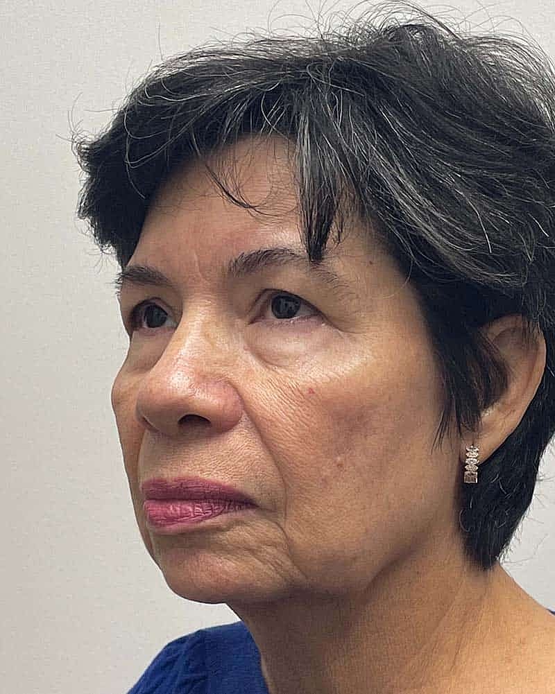 Blepharoplasty Before & After