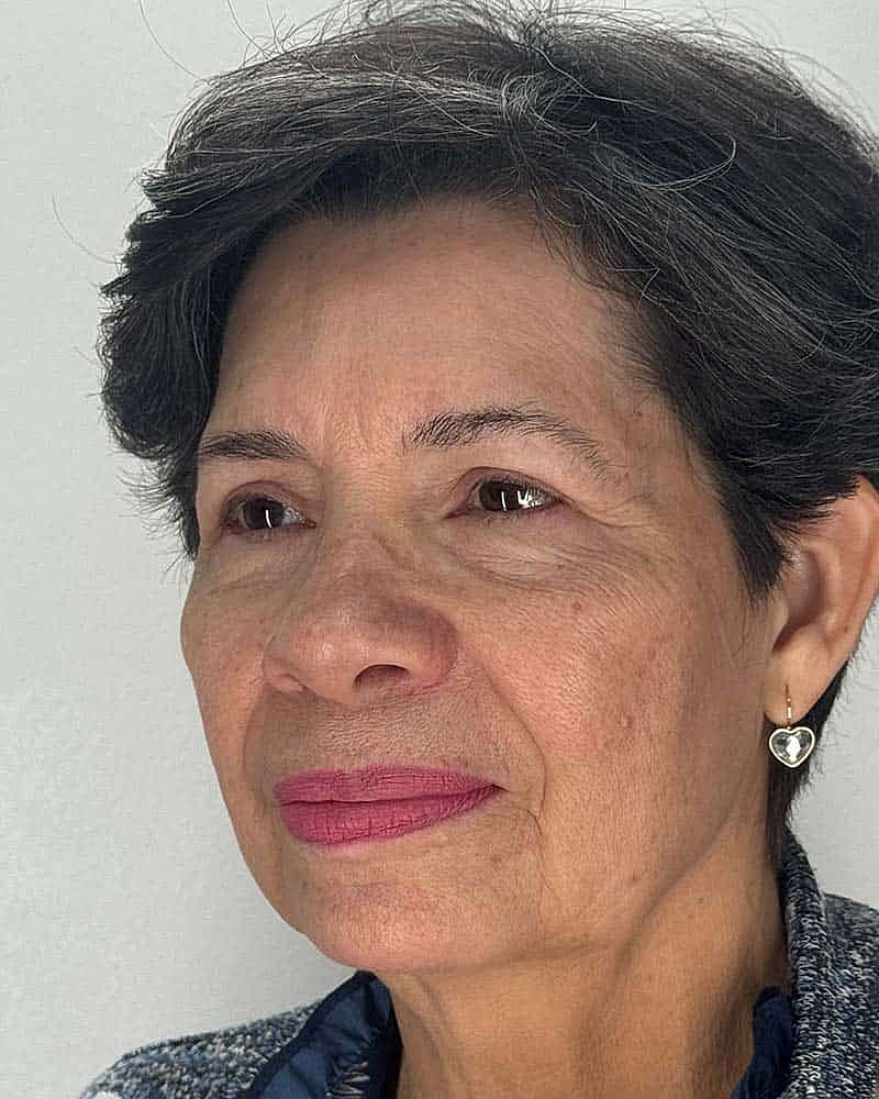 Blepharoplasty Before & After