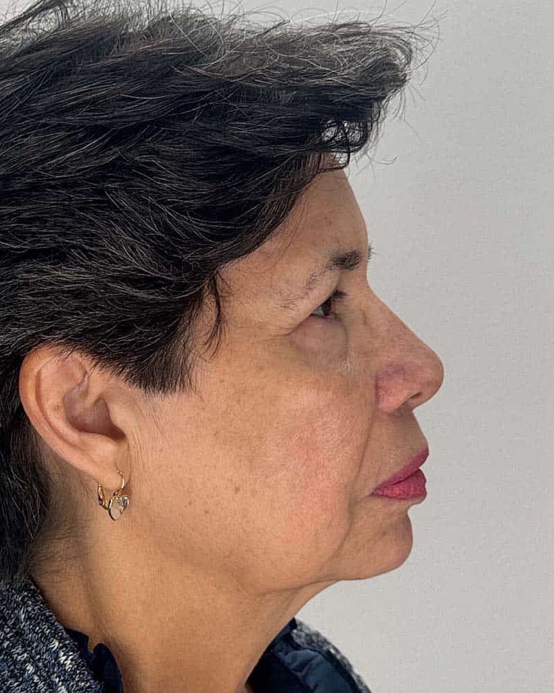 Blepharoplasty Before & After