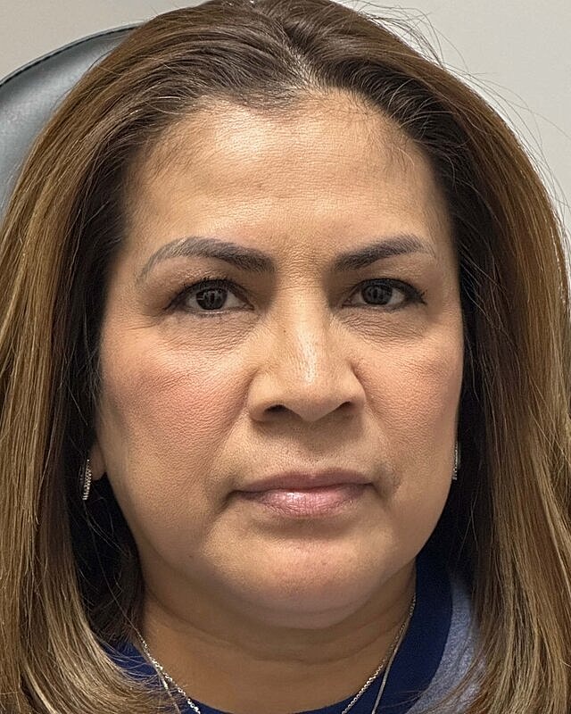 Blepharoplasty Before & After