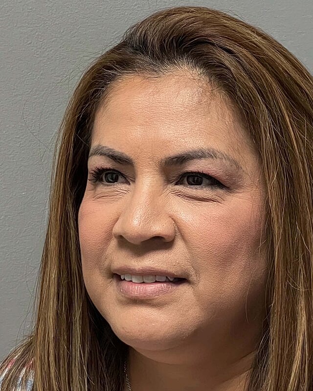 Blepharoplasty Before & After