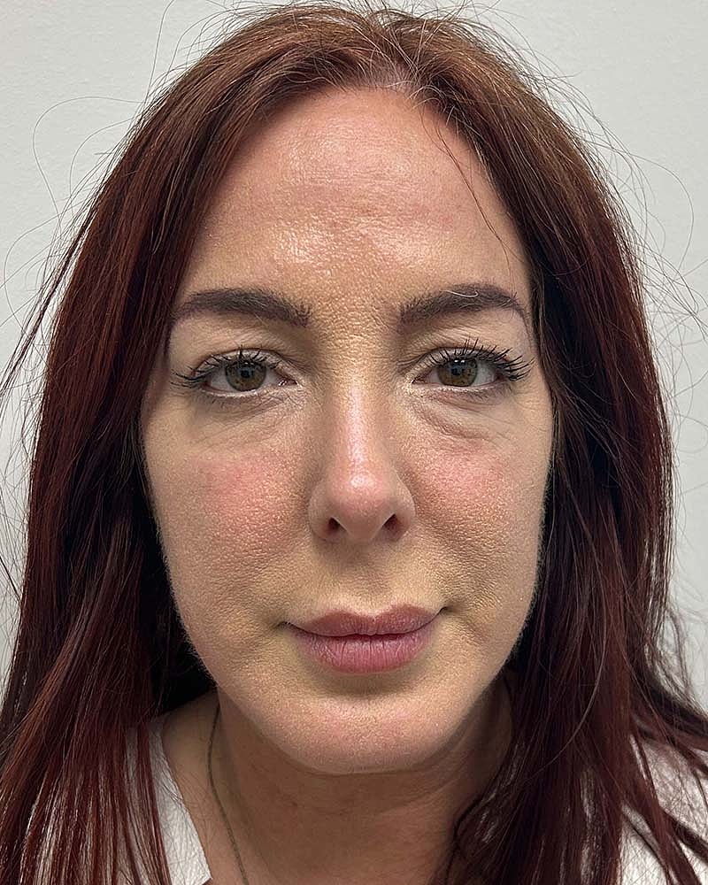 Blepharoplasty Before & After