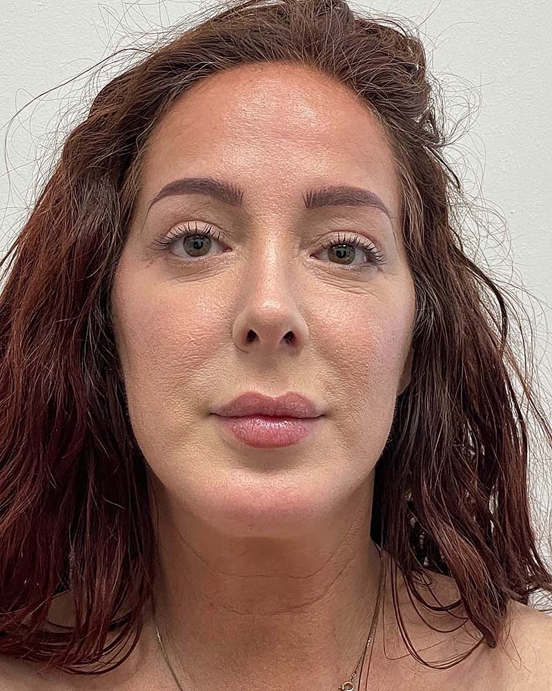 Blepharoplasty Before & After