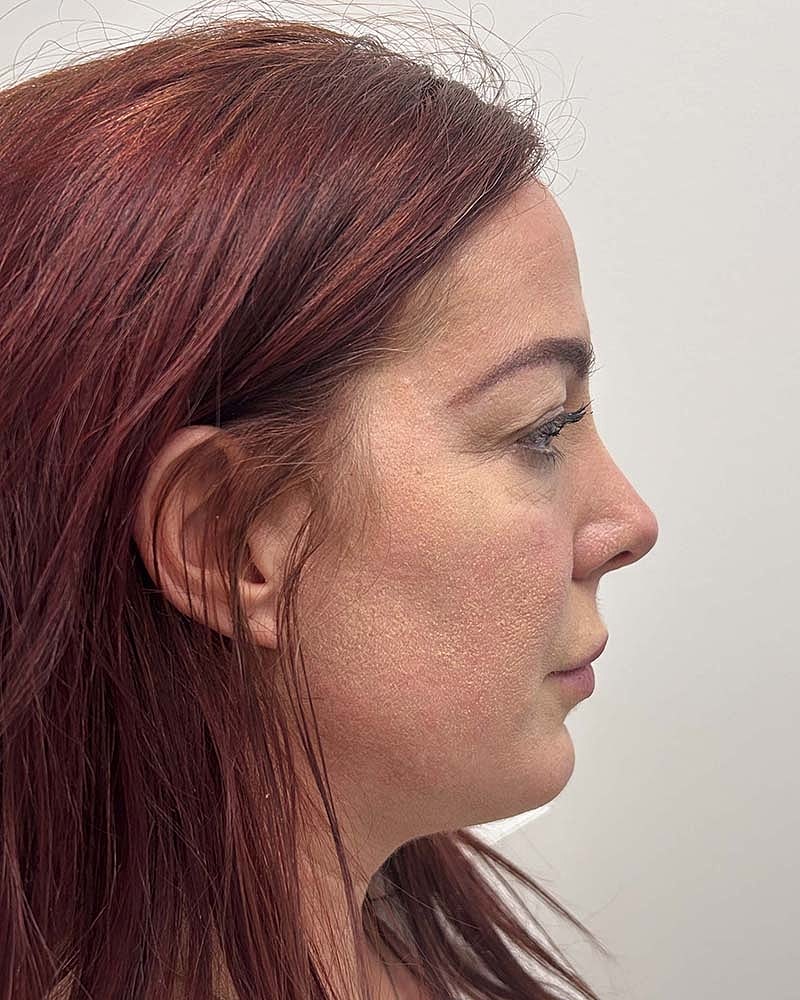 Blepharoplasty Before & After