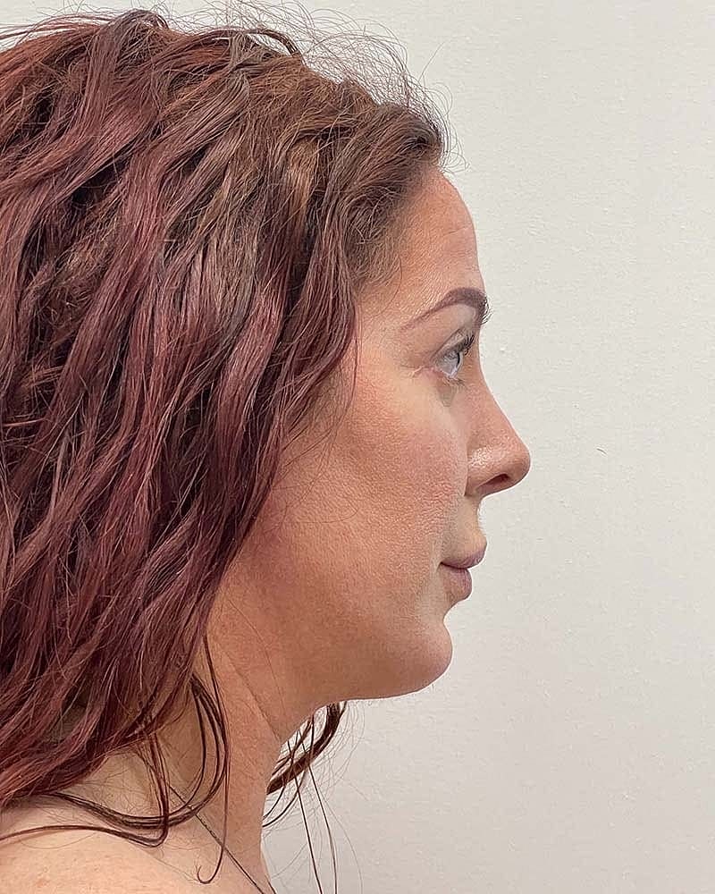 Blepharoplasty Before & After