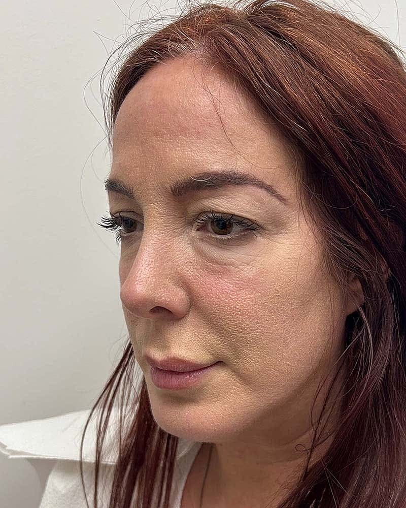 Blepharoplasty Before & After