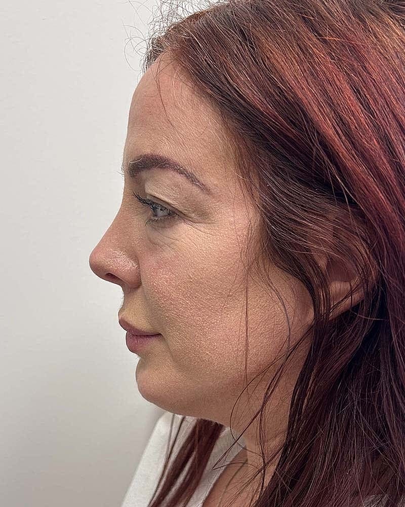 Blepharoplasty Before & After