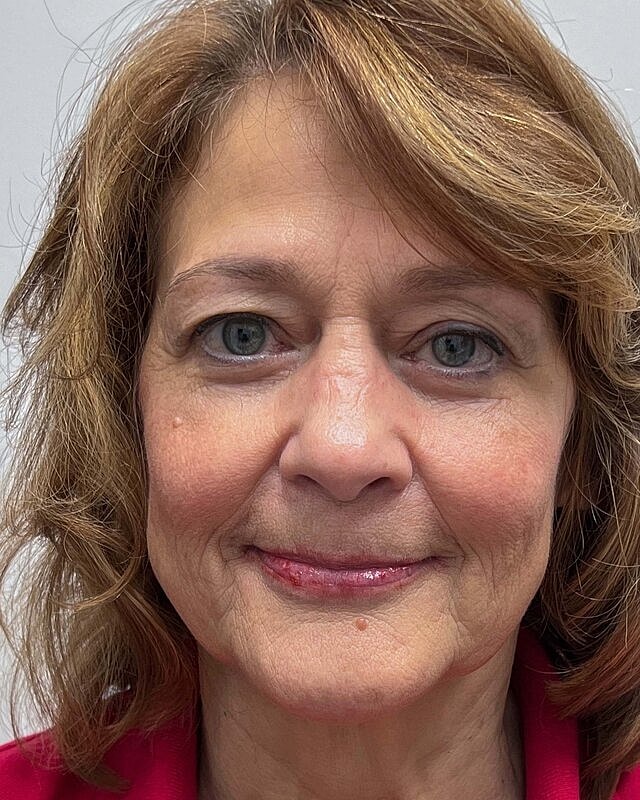 Blepharoplasty Before & After