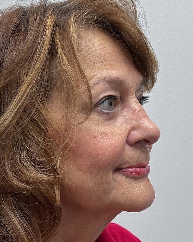 Blepharoplasty Before & After