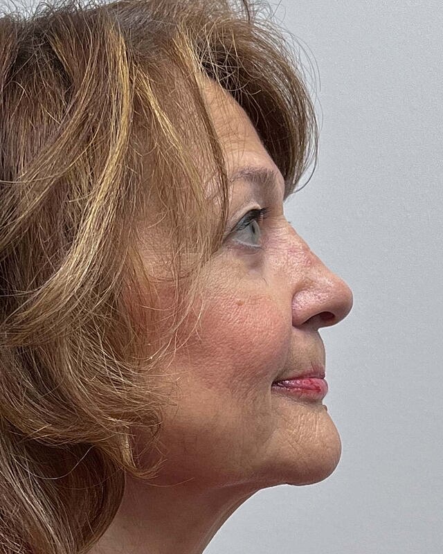 Blepharoplasty Before & After