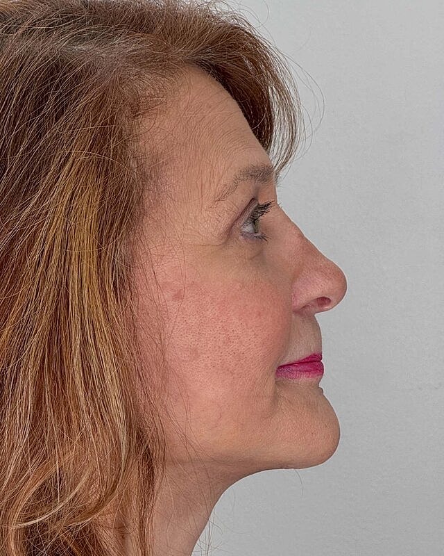 Blepharoplasty Before & After