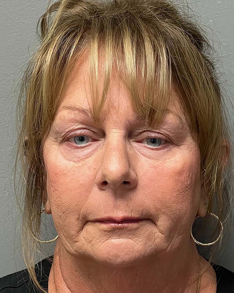 Blepharoplasty Before & After