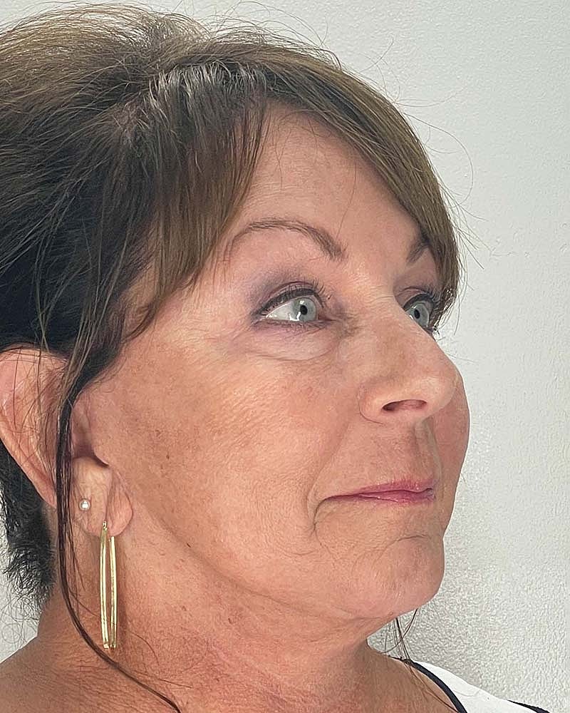 Blepharoplasty Before & After